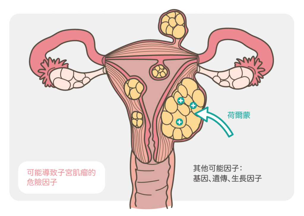 子宮肌瘤成因