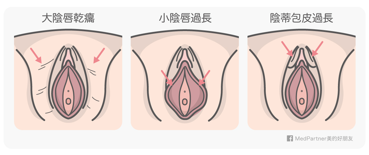 外陰部的各種問題