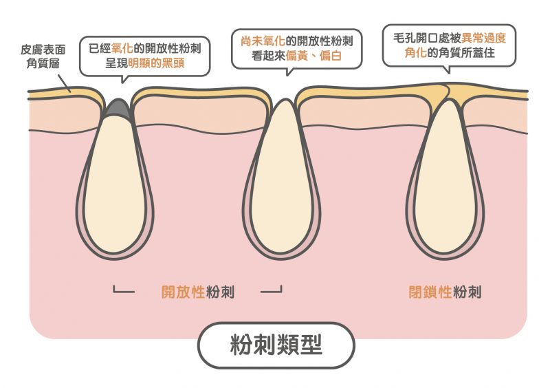 粉刺類型