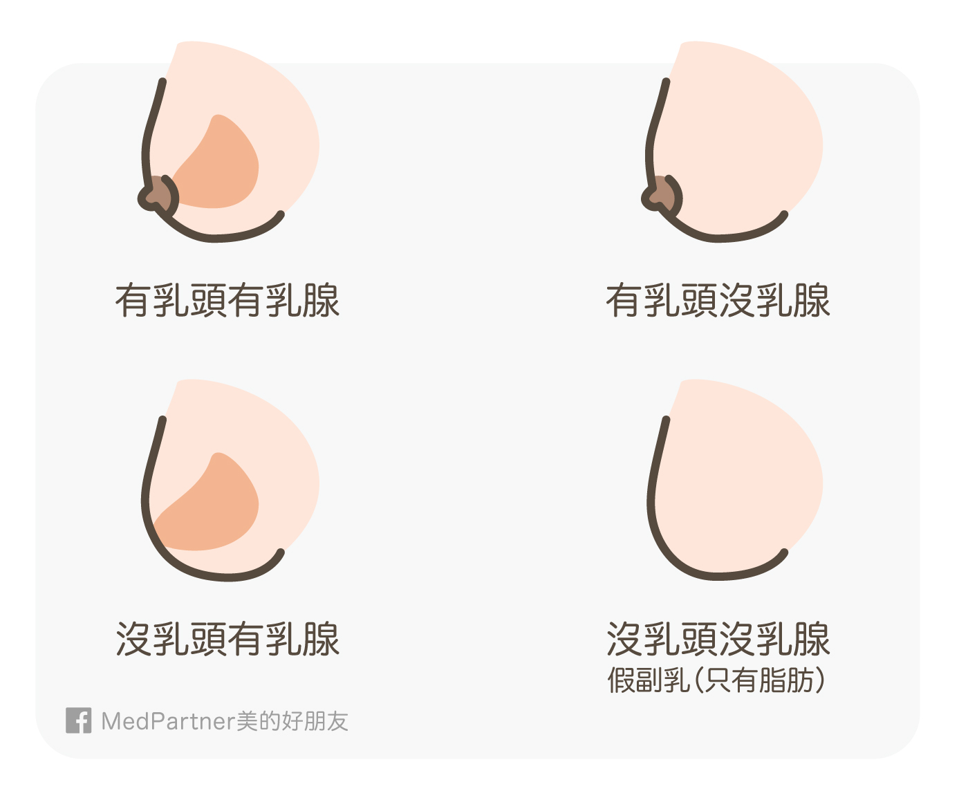 乳房的四種型態
