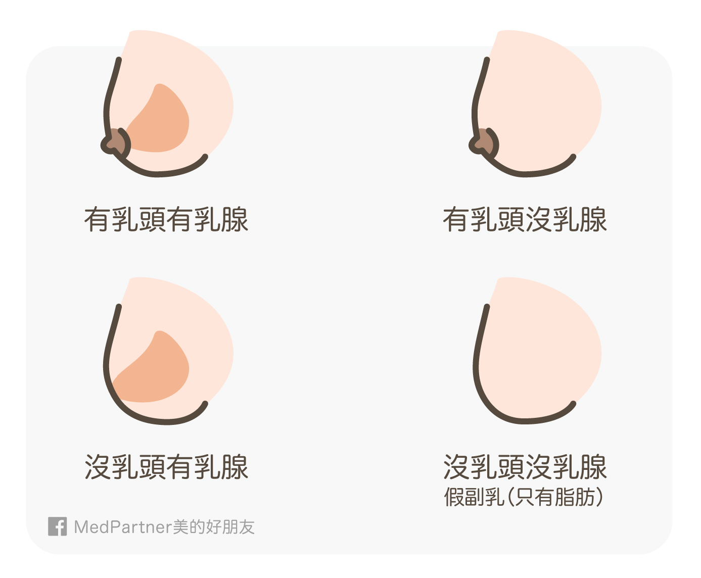 乳房的四種型態