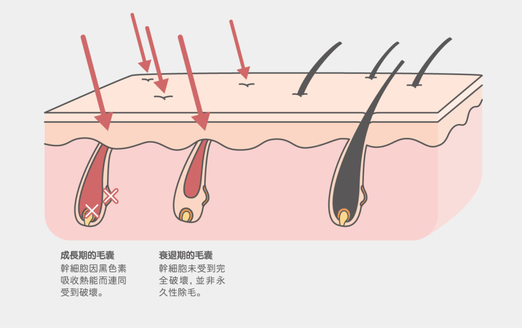 除毛_雷射