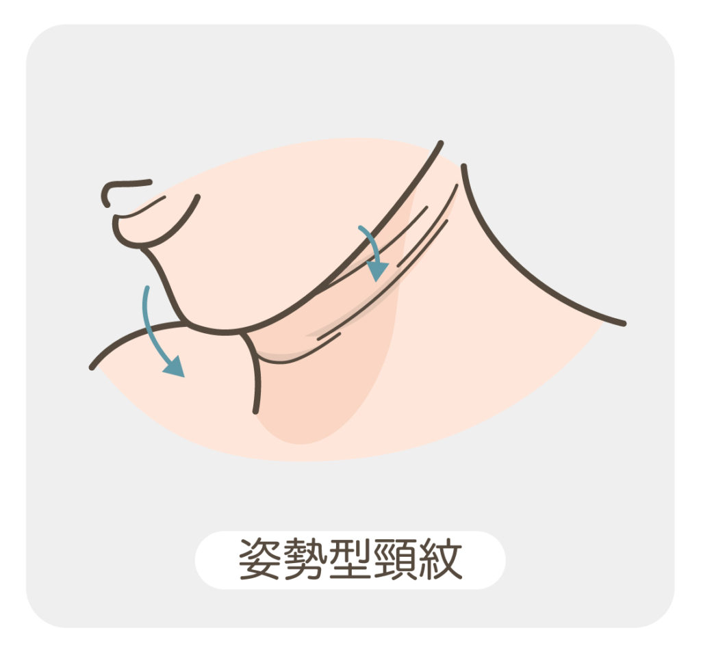 頸紋_姿勢型