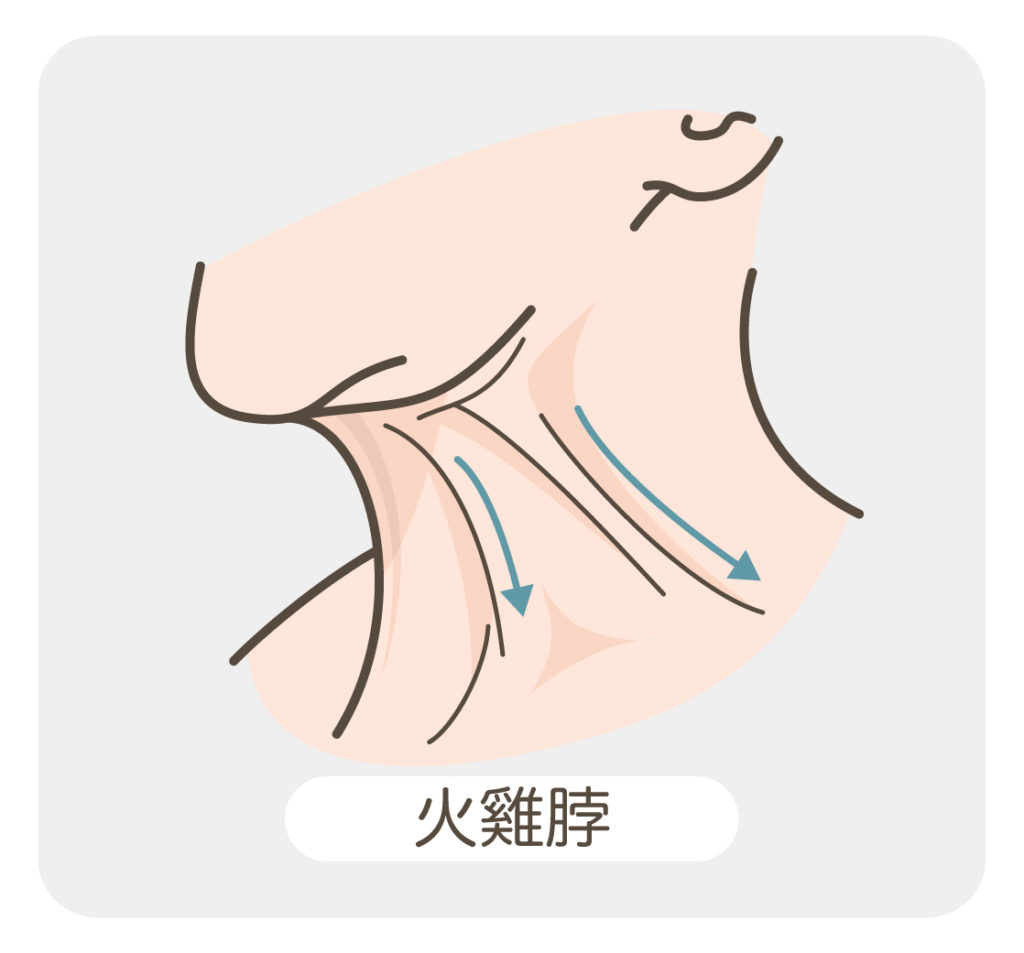 頸紋_火雞脖