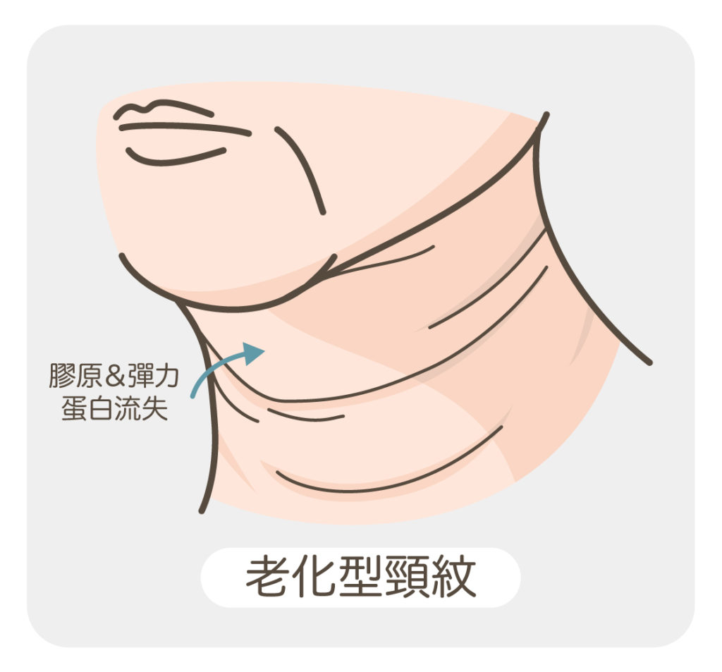 頸紋_老化型