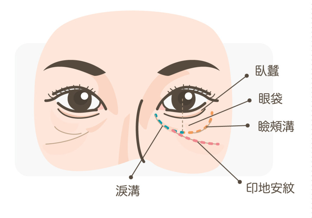 眼袋_淚溝印地安紋眼袋瞼頰溝臥蠶