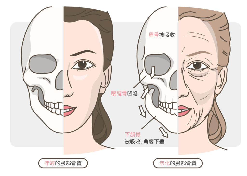 臉部骨質的老化