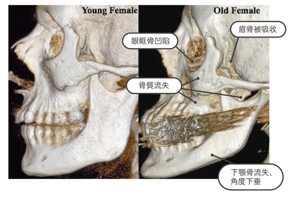 美白part2_骨質比較照片