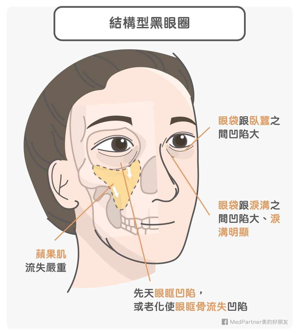 黑眼圈_結構型