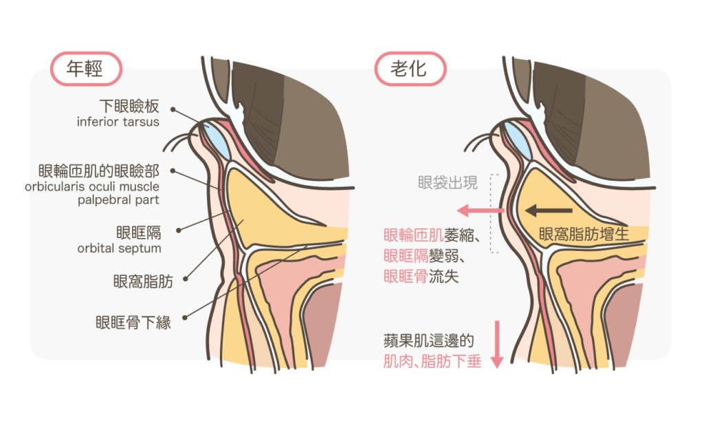 眼袋_年輕與老化眼睛解剖