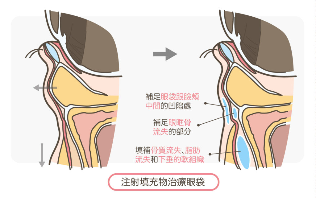 眼袋_注射填充物治療