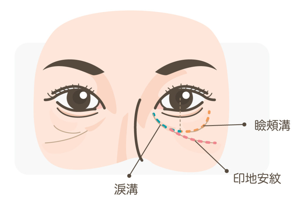 眼袋_淚溝印地安紋瞼頰溝