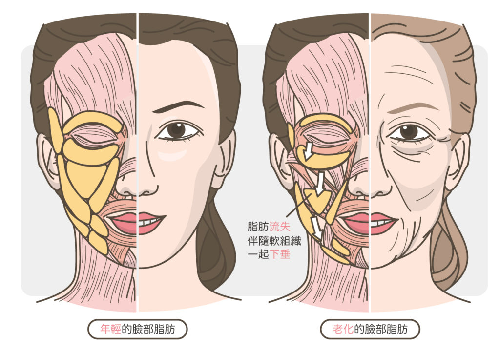 臉部脂肪的老化