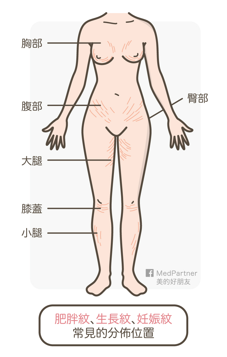 妊娠紋生長文肥胖紋的好發位置