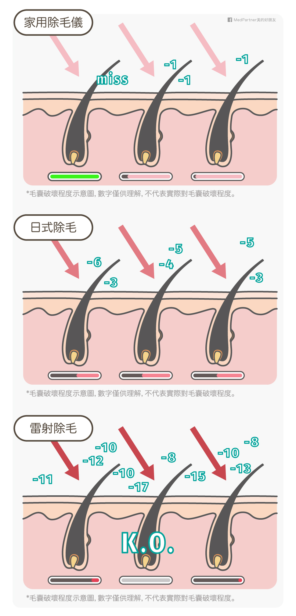 毛囊破壞程度示意圖