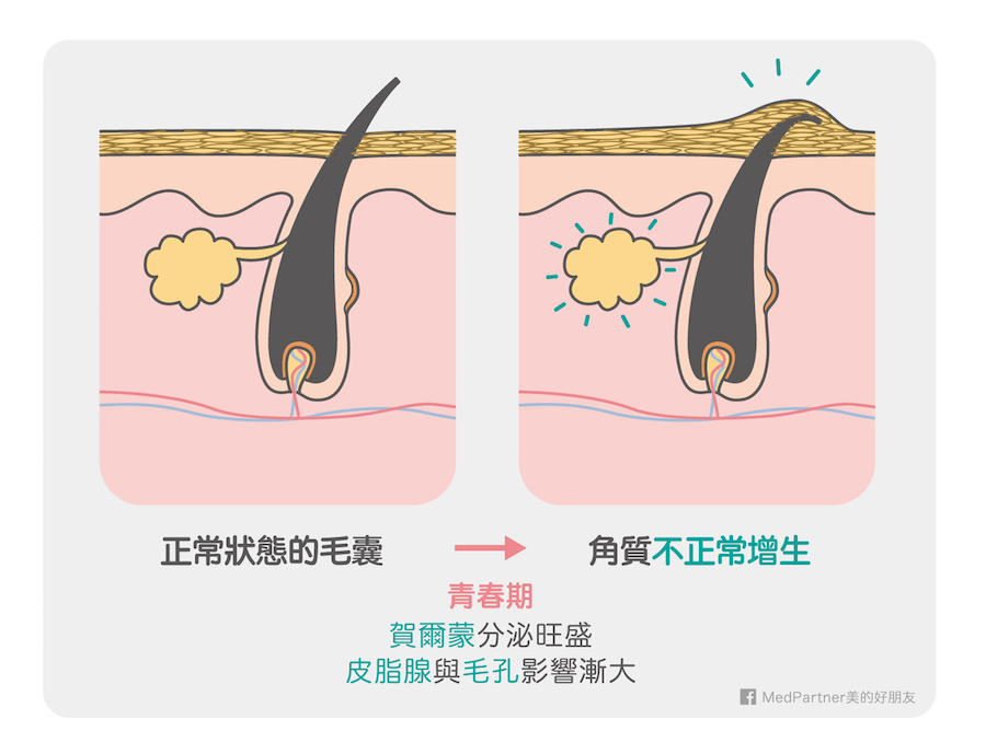 毛孔角化