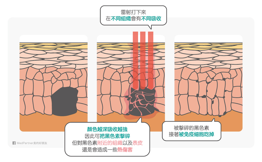 雷射擊碎黑色素