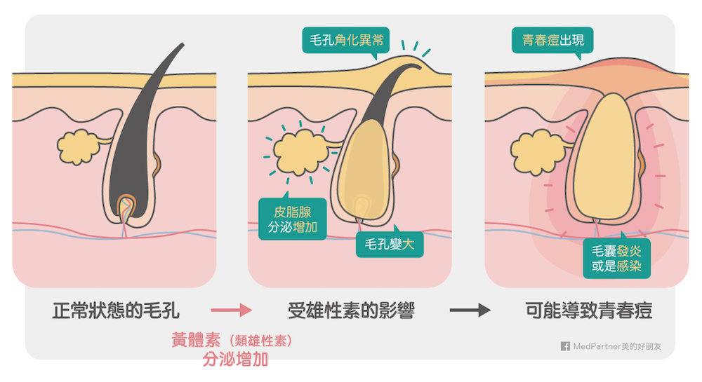 生理痘成因