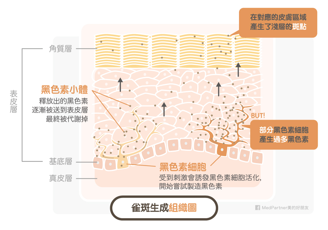 雀斑組織圖＿生成原因