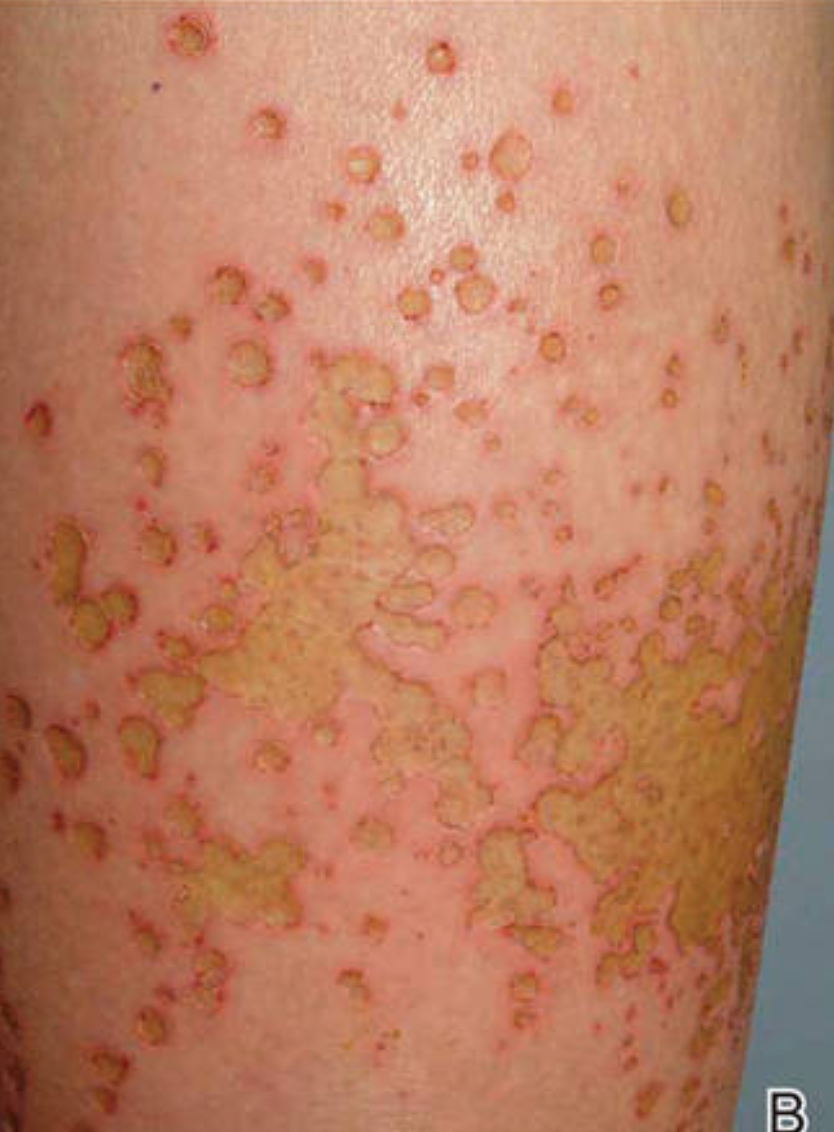 Photo credit： Sulfur Spring Dermatitis, Cutis. 2014 November;94(5):223-225
