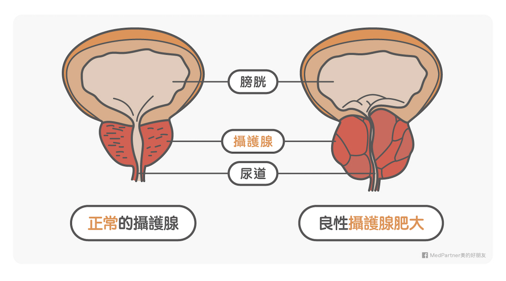 攝護腺肥大成因、預防與治療醫師圖文完整解說| 美的好朋友