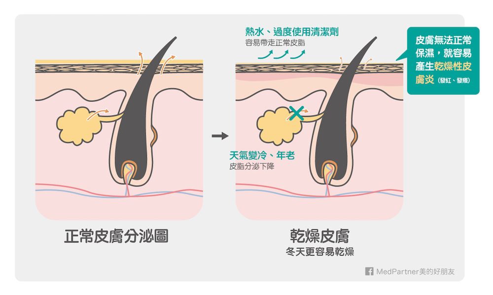 乾燥性皮膚炎