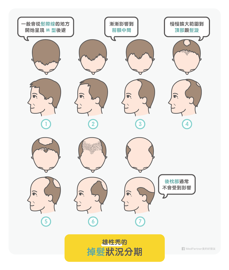 雄性禿治療