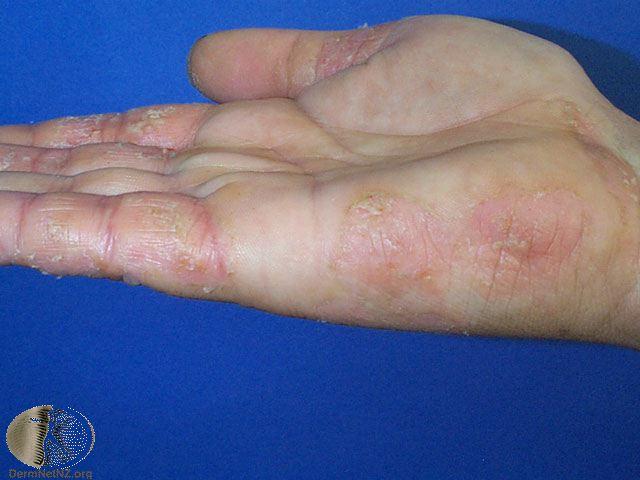 反覆發作在手部的異位性皮膚炎