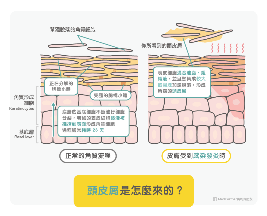 角質流程與頭皮屑來源