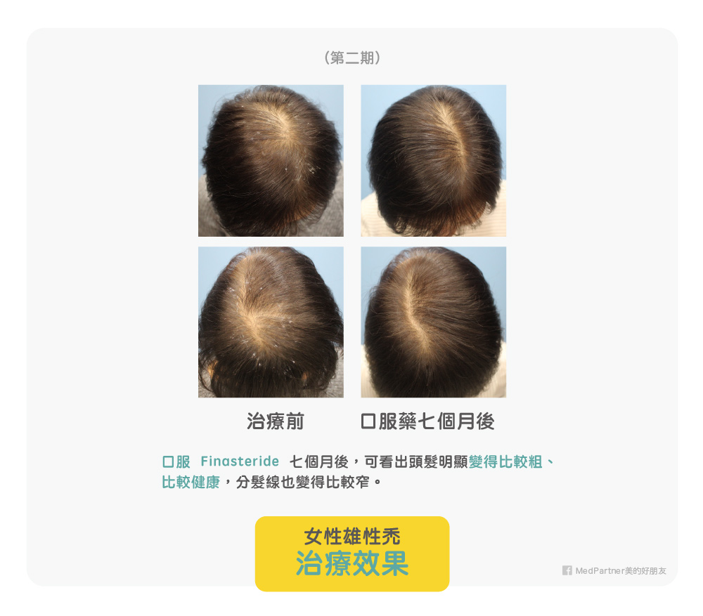 女性第二期口服 Finasteride 治療效果