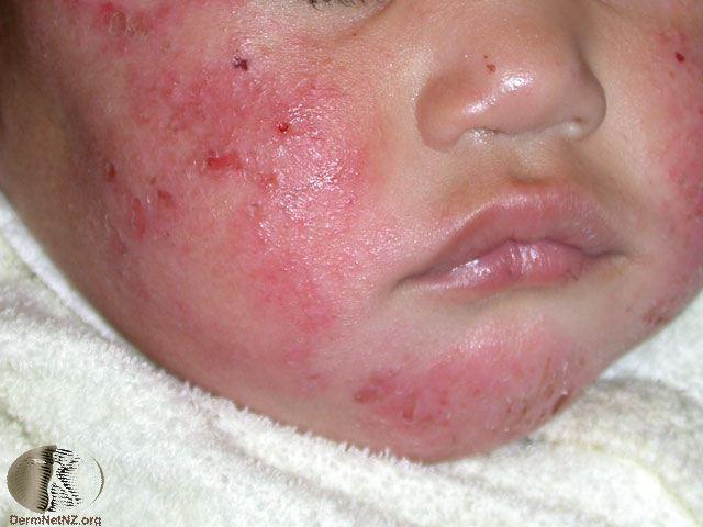 嬰兒臉上的異位性皮膚炎