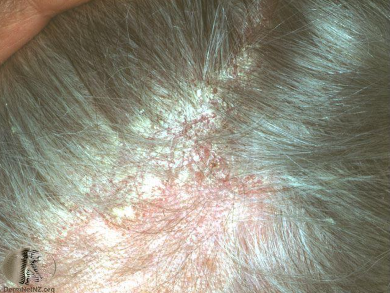 發生在成人頭部的脂漏性皮膚炎，出現發炎、發紅、脫屑的反應