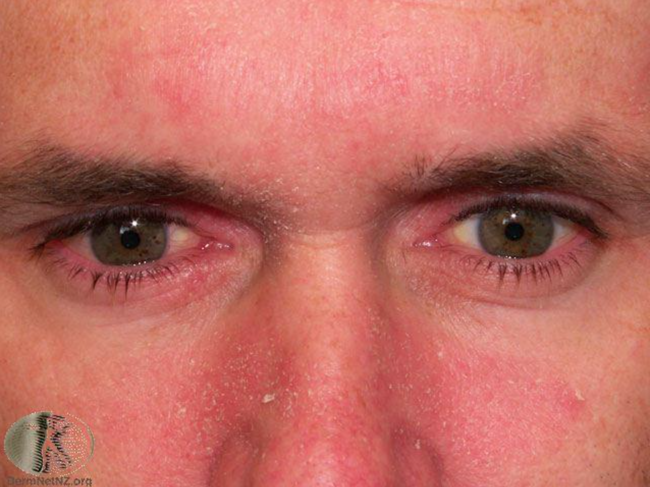 成人臉部的脂漏性皮膚炎，在眉毛及鼻翼兩側出現發炎以及脫屑反應。