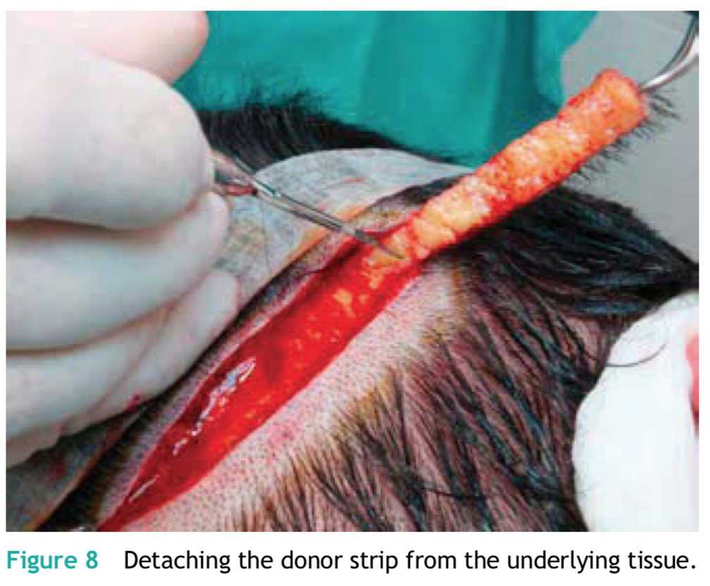 FUT植髮手術取頭皮過程