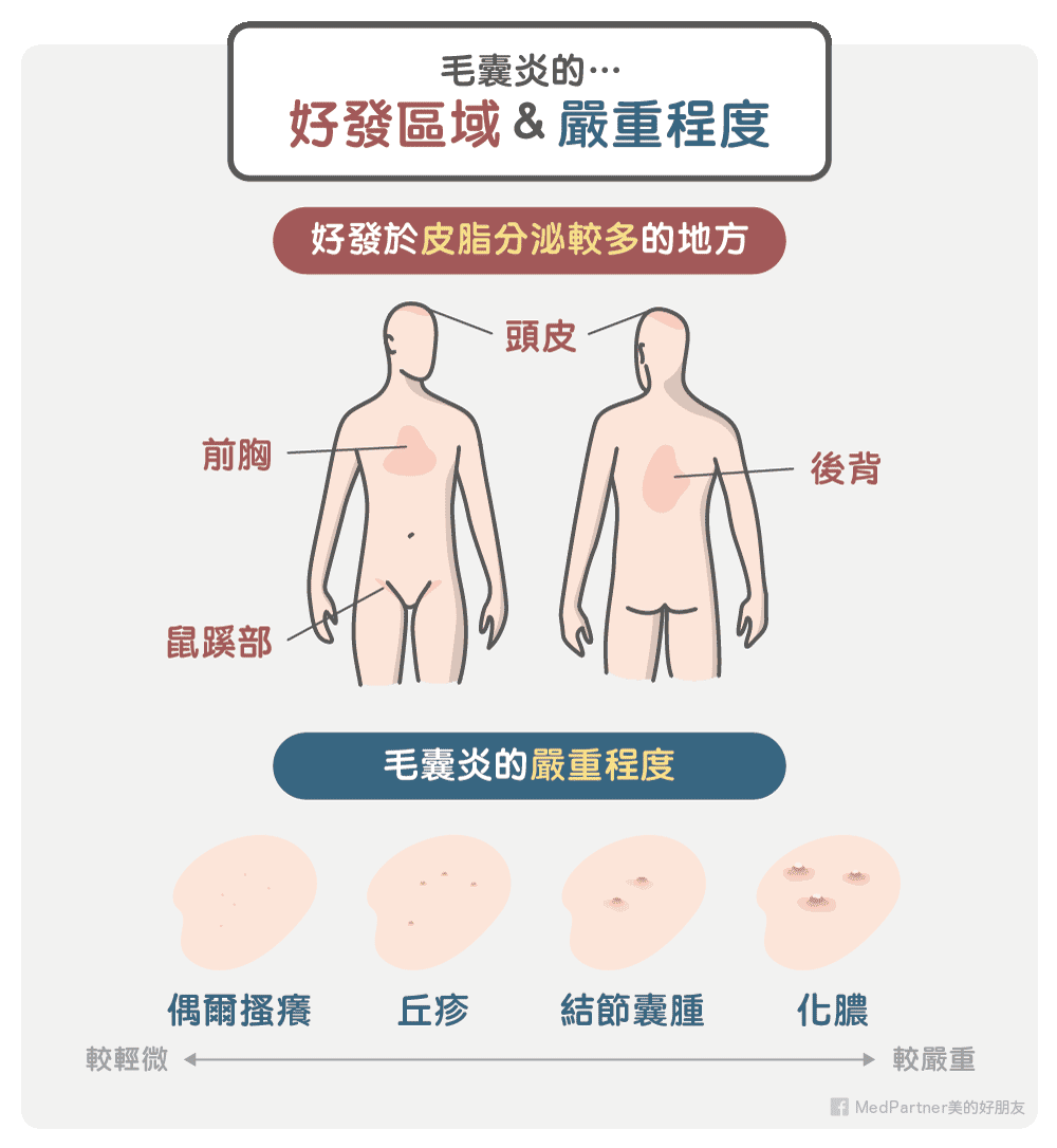 毛囊炎的好發區域與嚴重程度