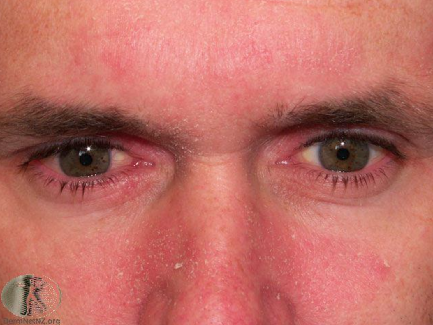 成人臉部的脂漏性皮膚炎。