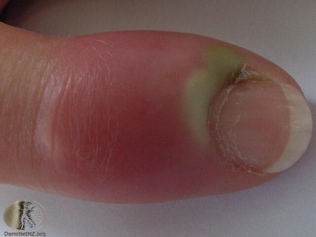 急性甲溝炎 acute paronychia：近端甲褶紅腫發炎，且有形成膿瘍。