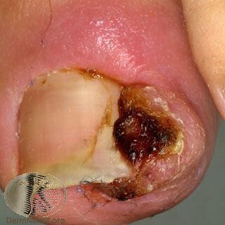 Ingrown toenail