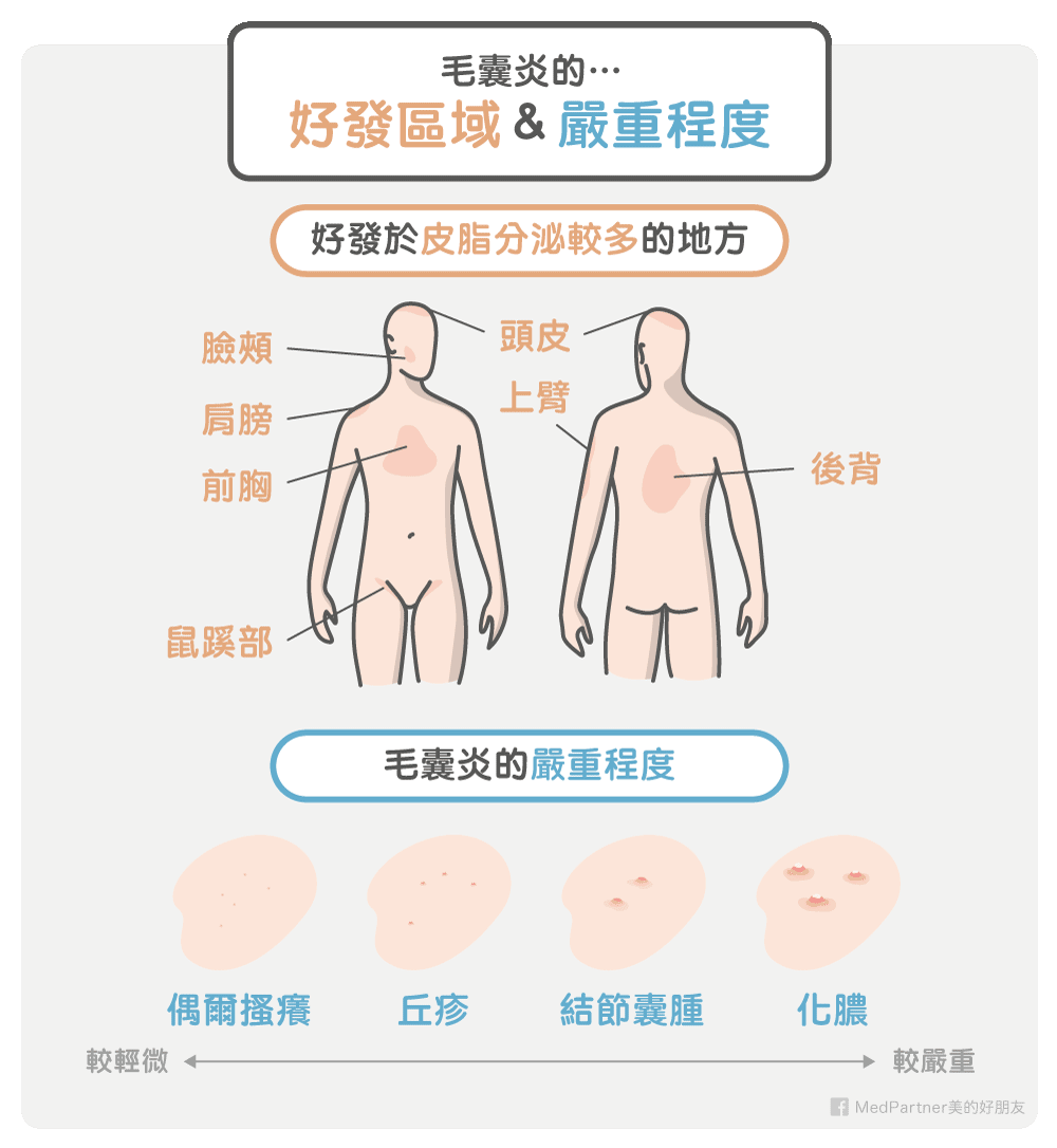 毛囊炎好發區域與嚴重程度