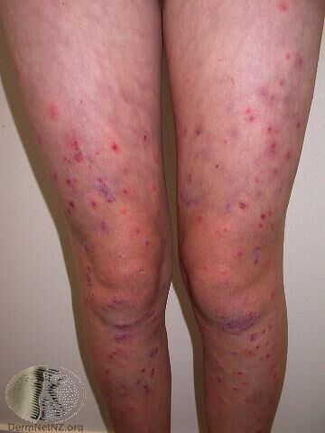 雙下肢多處出現紅腫、發炎反應的毛囊炎