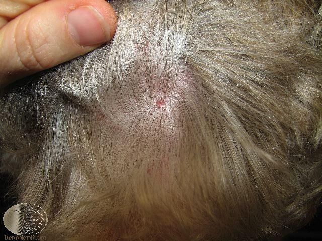 出現在頭皮的乾癬，有明顯的銀色脫屑反應