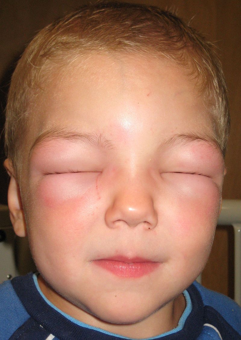 發生在眼部的血管性水腫（Angioedema）