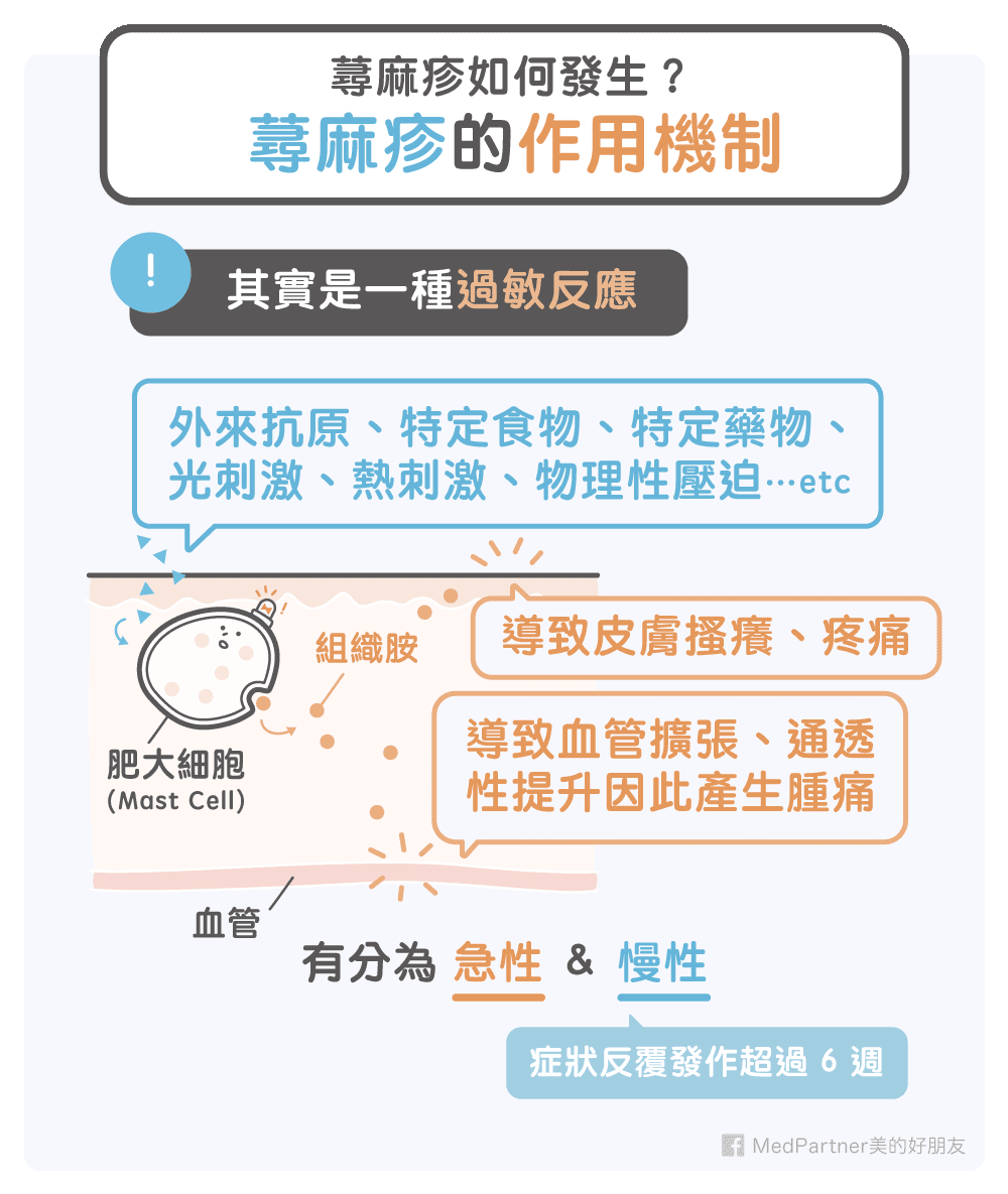 蕁麻疹作用機制