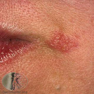 最常見的皰疹類型：長在唇邊的群聚性的小水泡