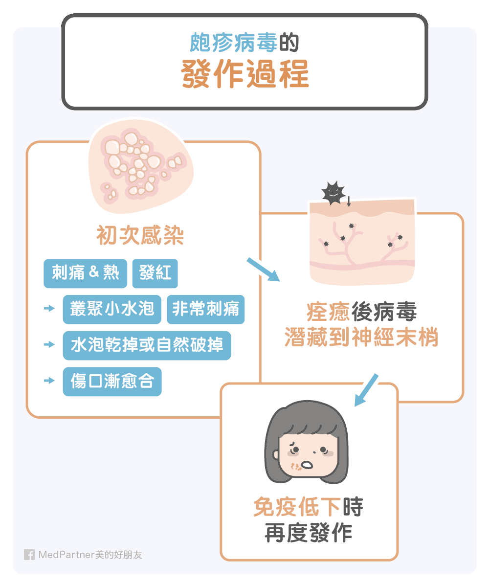 皰疹病毒的發作過程