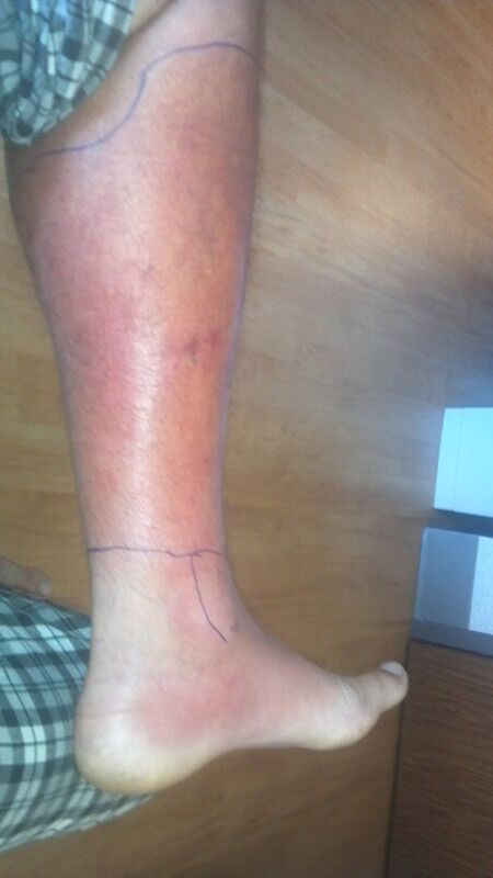 下肢的蜂窩性組織炎，侵犯到足部。
