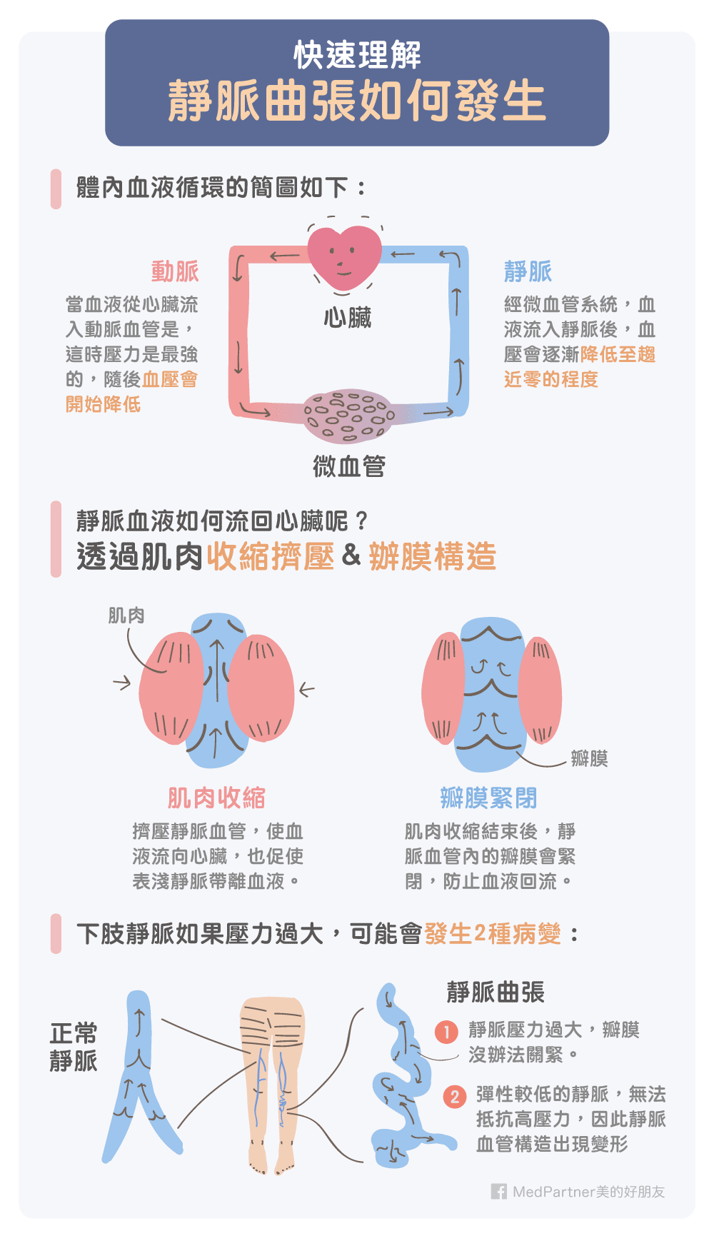 靜脈曲張如何發生