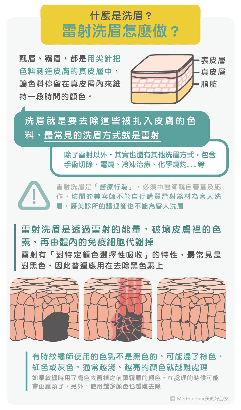 雷射洗眉概要