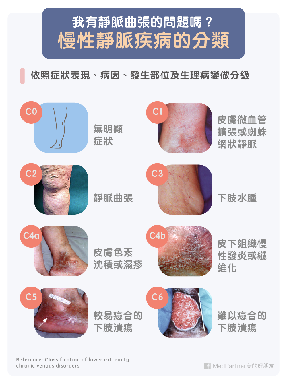 慢性靜脈疾病的分類