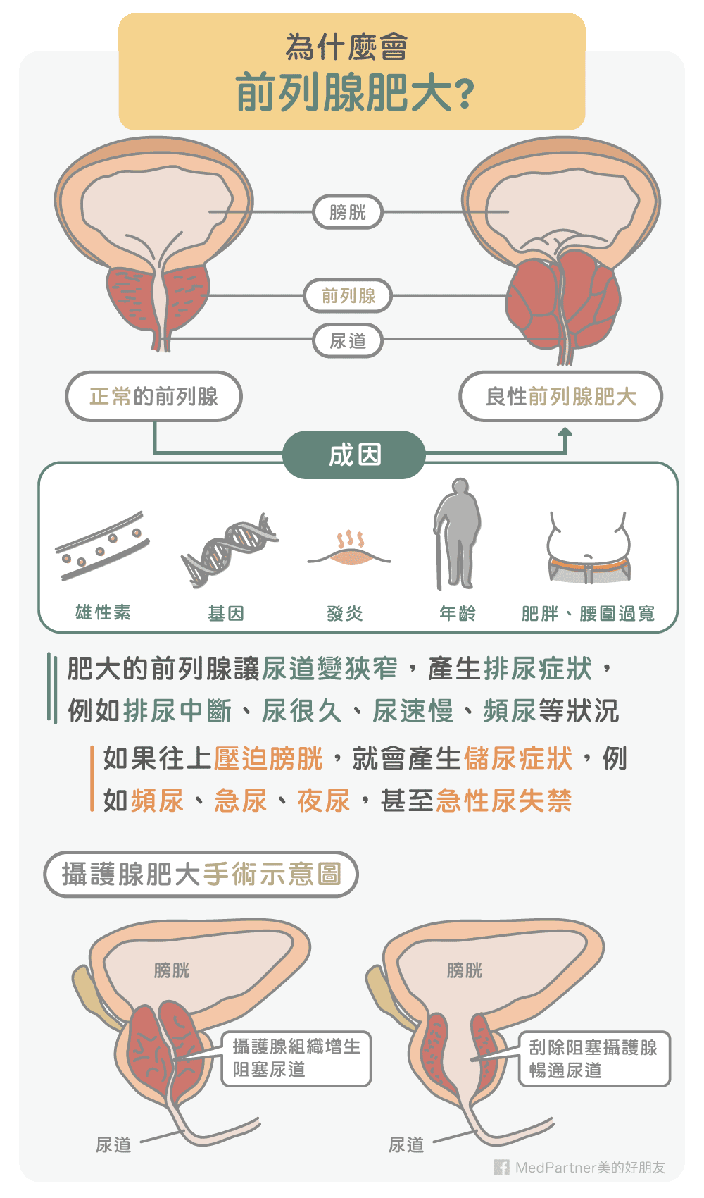 前列腺（攝護腺）肥大原因